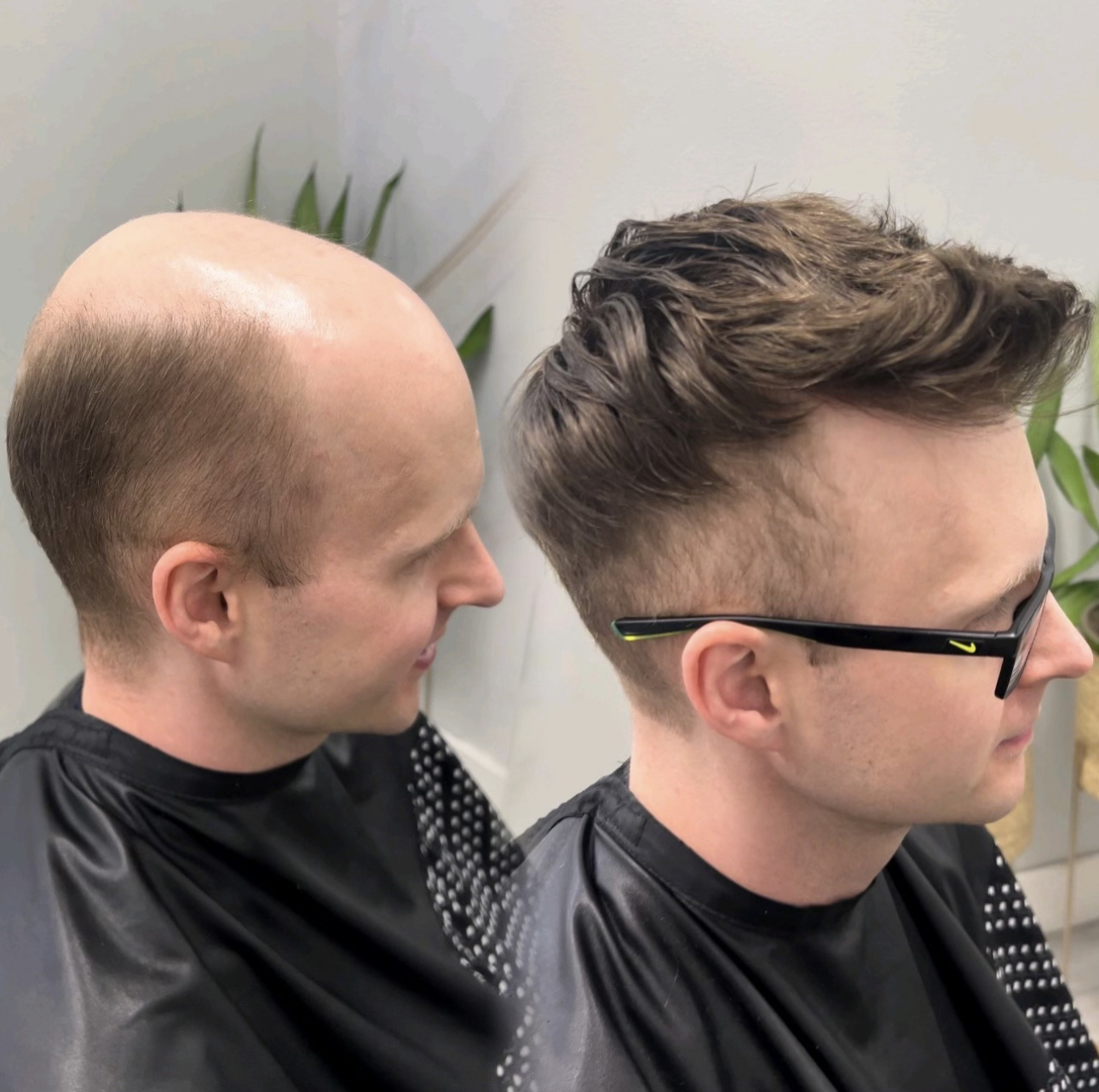 Before-and-after custom hair system result for a client